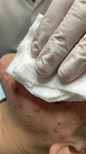 Satisfying Acne Extraction – Inflamed Whiteheads & Cysts