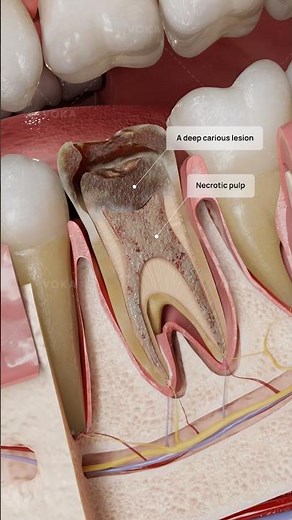 From Small Cavity to Abscess: Why Early Treatment Matters