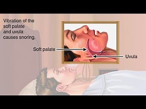 How & Why Snoring Occurs Animation - Where Snoring Comes From What Happens - Causes of Snoring Video