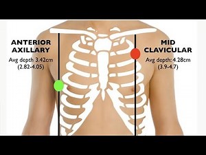needle decompression for tension pneumothorax some tips and tricks#pneumothorax #medical #media