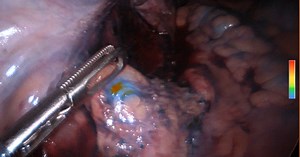 ‘Sight Beyond Sight’: Green Bay surgeons spot hidden cancer with breakthrough dye