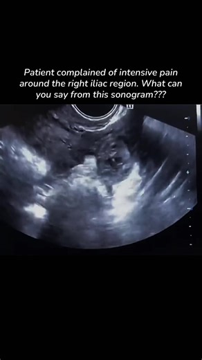 Understanding Right Iliac Pain Through Ultrasound