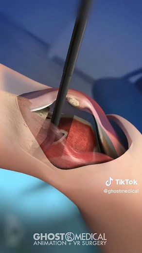 Medtronic’s Aquamantys electrosurgical device is a RF bipolar sealer that is used for hemostatic sealing and coagulation of soft tissue. The sealer provides significantly less blood loss, better visualization of surgical site, and less operating room time for certain procedures. In this medical animation, the device is used during a knee replacement. #kneereplacement #surgerytiktok #orthopedics #medicaldevice #processvideo #interestingfacts