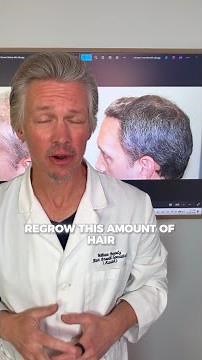 He Lost Hair for 10 Years | We Fixed It in 90 Days by Removing One Thing