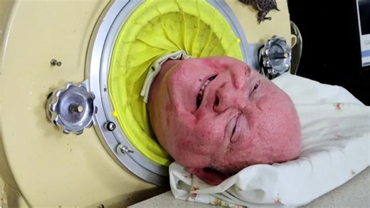70K views · 646 reactions | Paul Alexander, a man who lived most of his life in an iron lung, has died at age 78. https://tinyurl.com/3m8v28bf | USA TODAY | Facebook