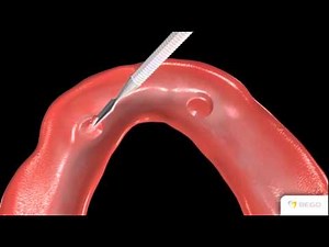 BEGO - Colocación de Locator® en clínica