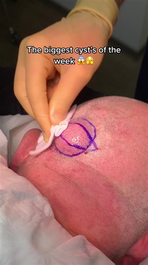 Largest Cysts of the Week 😱