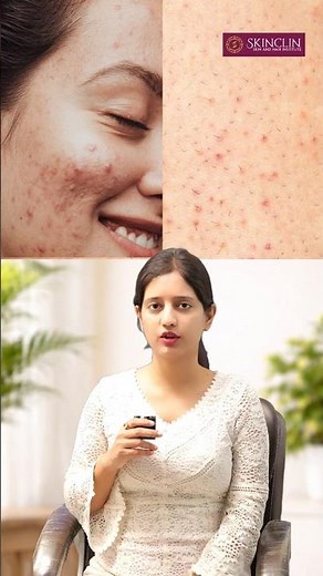 Arm Par Pimples? STOP Calling It Acne! | Keratosis Pilaris Explained