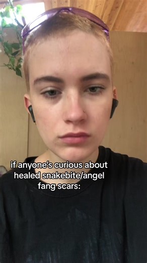 Healed Snake Bite and Angel Fang Scars: A Comprehensive Guide