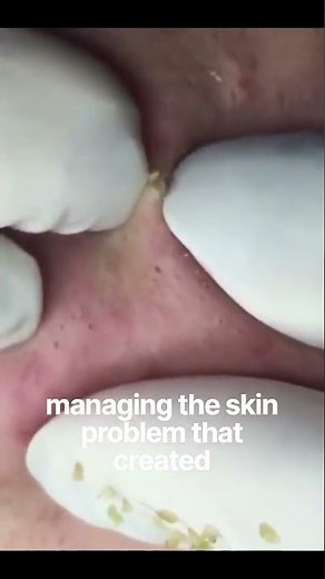 #blackheads #acne #pimplepopping #skincare #satisfying #acnetreatment #blackpink #youtubeshorts