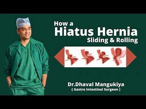 How a Hiatus Hernia Sliding & Rolling is Formed | Symptoms and Treatment | Dr.Dhaval Mangukiya