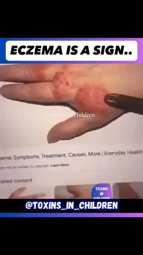 It’s a sign.. So many skin issues and other symptoms in the body can be traced back to a hidden root cause: parasites. Yep, those little freeloaders are wreaking havoc inside without you even realizing it! Parasites don’t just exist in the body they thrive. They feed off nutrients your body needs to function, steal essential minerals, and even harbor heavy metals. But that’s not all. They actually use those metals to protect themselves, creating a toxic fortress in your body. It’s a vicious cycl