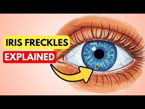 Iris Freckles: Harmless or Dangerous?