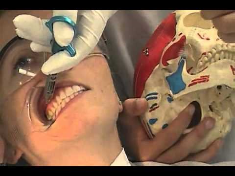 The Vazirani-Akinosi closed mouth mandibular block