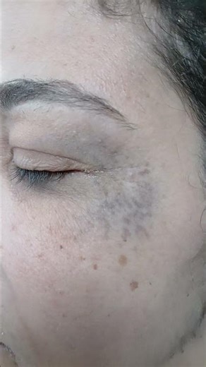 Nevus of Ota