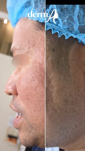 The Atlas Protocol — one treatment is all it takes. ✨️ There is A difference... ✨️ Inquire now❗️ 📌 Clinic Address: Unit 303, Xanland Place Condominium, Katipunan Avenue, Quezon City 📞 Telephone Number/ Viber ( 63)9569552877 To book for an appointment, please click on the link below. https://calendly.com/drapimplepopper/appointment #acnescarremoval #acnescars | Doctora Pimple Popper/ Doc Athena