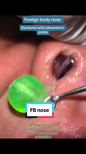Foreign Body Removal from Nose | ENT Specialist Procedure