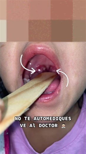 NIÑA CON INFECCIÓN DE AMÍGDALAS - FARINGOAMIGDALITIS #faringoamigdalitis #faringitis #infeccion #salud #medico #medicine #doctorexplains #health #bacterias #fyp #parati #pepe_pepp