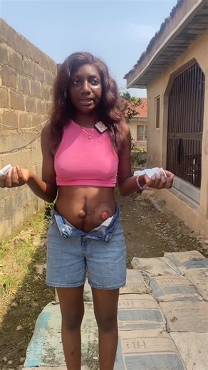 Tobiloba Oluwasina on Instagram: "Having a colostomy can be tiring but it’s what I signed up for right??? Yhh😊 #ostomate #cancersurvivor #cancersurvivour @who @aproko_doctor @mazitundeednut"