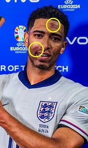 What are those marks on Bellingham's face? | Oh My Goal