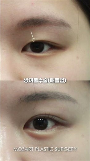 자연스럽게 예뻐지는 방법? 매몰법 쌍꺼풀 결과 공개