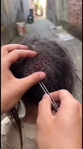 Ticks on Instagram: "Extreme tick infestation found. This video is for hygiene awareness and prevention only. Safe demonstration no medical advice. #ticks #lice #hygieneawareness #publichealth #awarenessvideo"