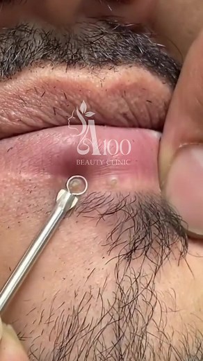 Blackhead Removal on Lips 2024