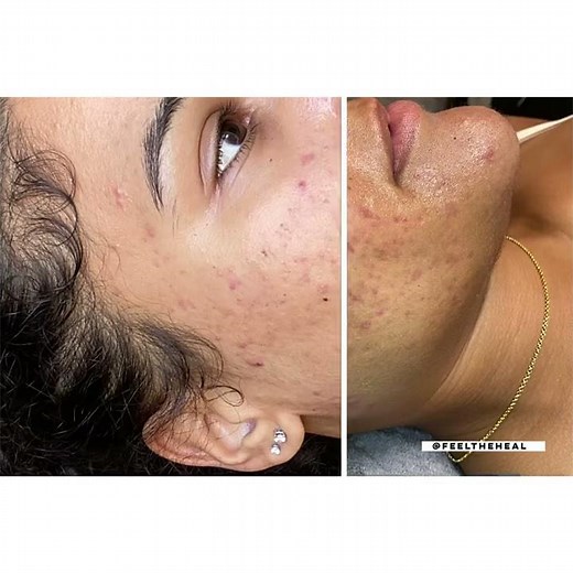 Microneedling with prp before and after