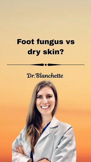 🦶 Is it REALLY dry skin… or could it be fungus? Most people assume flaky feet = dryness. But in podiatry, that’s rarely the full story. Here’s what I look for 👇✨ ⸻ 🧩 1. Dry, scaly skin that doesn’t improve If you’ve been moisturizing and nothing changes… that’s a big clue. Fungal infections often create patchy, flaky, or peeling skin that looks exactly like dry skin — but won’t go away with lotion. ⸻ 🦶 2. Nail changes Fungus doesn’t always stay on the skin. It can also affect the nails, caus