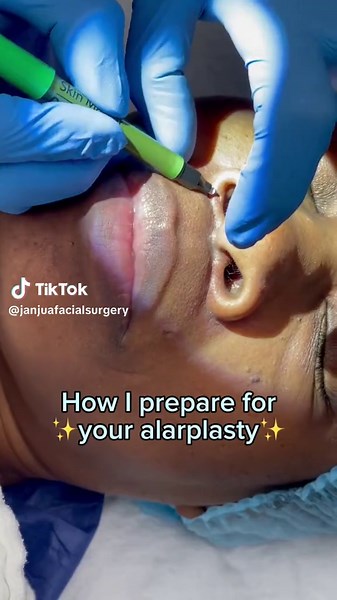 This is how I prepare your nose for alarplasty, carefully marking and measuring the width we're removing on both sides to keep everything symmetrical before we begin surgery. 👃🏽 22545 #alarplasty #alarplastynosejob #alarplastyresults #alarplastysurgery #alarplastybeforeandafter
