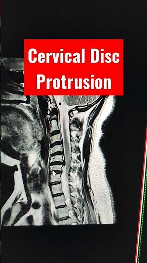 Cervical Foraminal Disc Protrusion of C5-6 level.