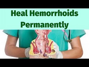 What Are Hemorrhoids? Causes,Symptoms And Treatment