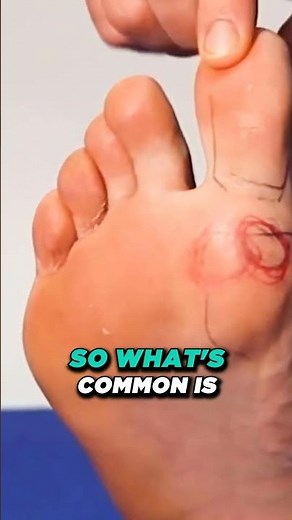 What is Sesamoiditis? [Sesamoiditis, Taping, Treatment, Exercises]