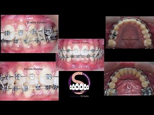 Bimaxillary protrusion treated without extraction🤔 Mostafa Elshafey