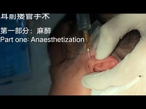 Preauricular Fistula Surgery（Part one:Anaesthetization）耳前瘘管手术（第一部分：麻醉）2023-08-15
