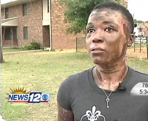 Woman Who Got Burned By Her Father Speaks Out!