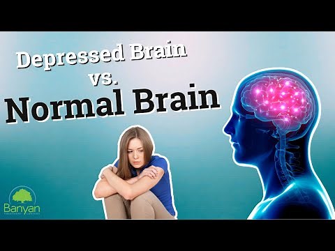 Depressed Brain vs Normal Brain