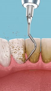 Oral Hygiene Scaling Root Planing Conventional Stock Footage Video (100% Royalty-free) 3575004935 | Shutterstock