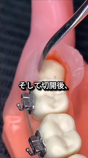 [Dentistry] Why cut the gums? → Teeth growing in an abnormal direction discovered