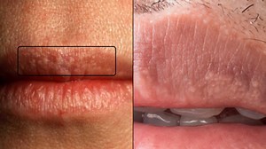 Reason behind the weird white bumps you can find on your private parts