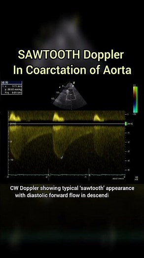 Sawtooth Doppler of Coarctation of Aorta on Echocardiography #cardiology