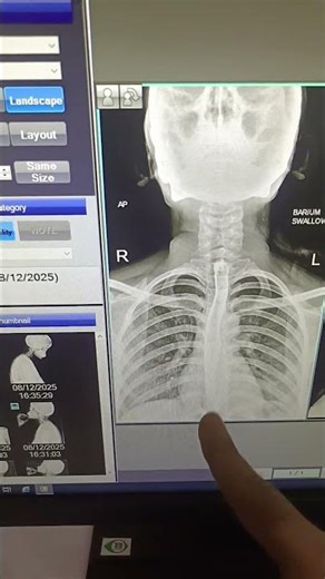 Barium swallow X-ray #_trending ‪@radiologylecture9780‬ ‪@digitaldrx-ray‬ ‪@udayxray‬