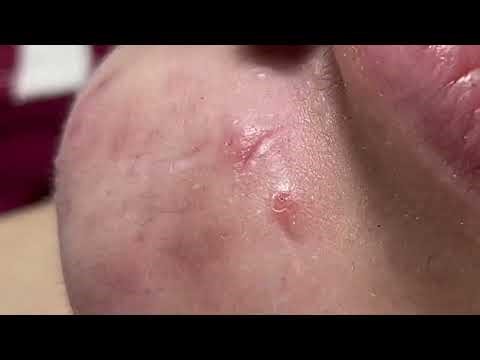 Single Acne - Acne Treatments Mai Ngoc 💕💕💕