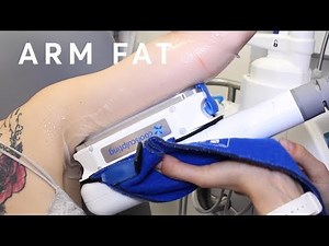 How to reduce arm fat? - Fat Freezing
