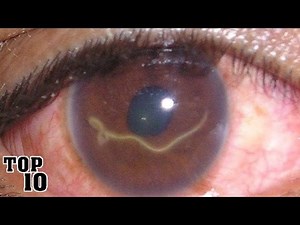 Top 10 Scariest Human Parasites