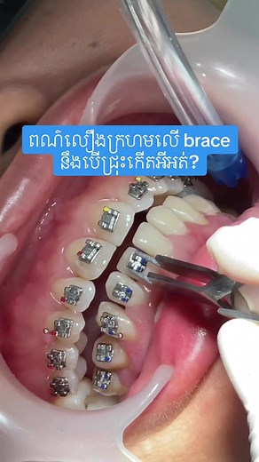 BRIGHT SMILE DENTAL HOSPITAL នៅលើ TikTok