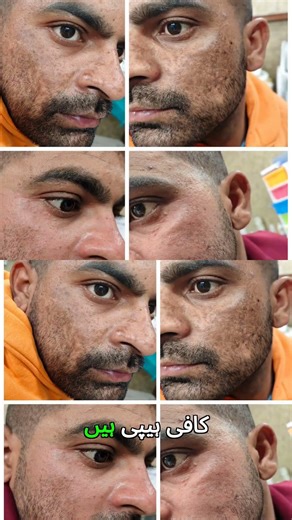 Stitch scar 6 mahine baad bhi dikhai de raha hai - yeh karein #ScarHealing #LaserClinic #HealthTips