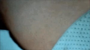 Breast Augmentation - Closing the Incision (GRAPHIC)