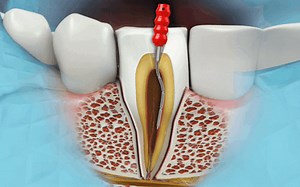 Endodontics | Arabic Lectures - Denteach