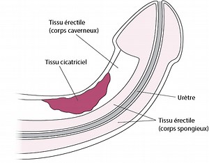 Dysfonction érectile (DE) - Problèmes de santé de l’homme - Manuels MSD pour le grand public